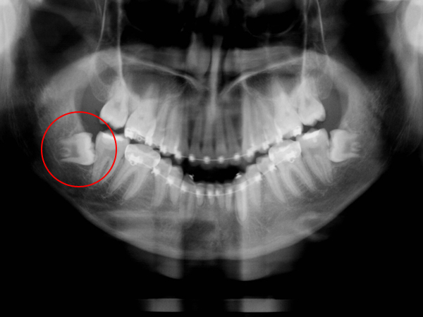 腫れた歯の治療